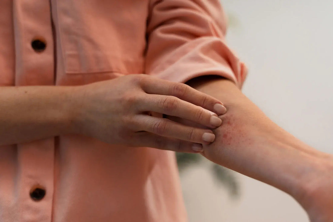 Kako ublažiti akutne izbruhe atopičnega dermatitisa z visoko koncentracijo kalamina - Skinfairytale